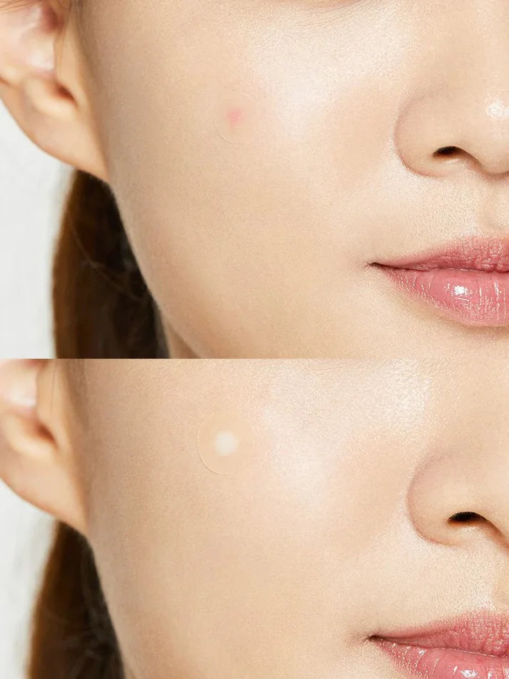 COSRX - Acne Pimple Master 24 patches